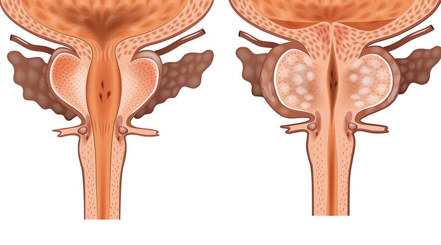 egészséges és gyulladt adenoma összehasonlítása