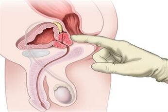 Prosztata masszázs krónikus prosztatagyulladás kezelésére
